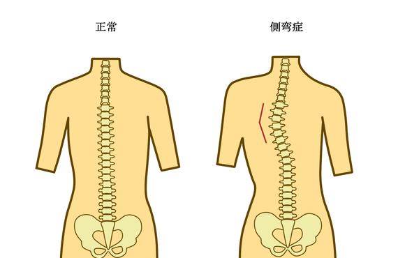 腰痛などを伴う側弯症について｜相模原市中央区共和・淵野辺にある身体健康アドバイザー「ゆりさく接骨院」